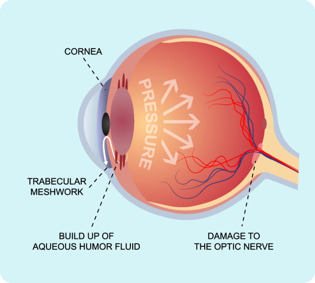 Diagram of the eye showing the optic nerve and intraocular structures illustrating glaucoma
