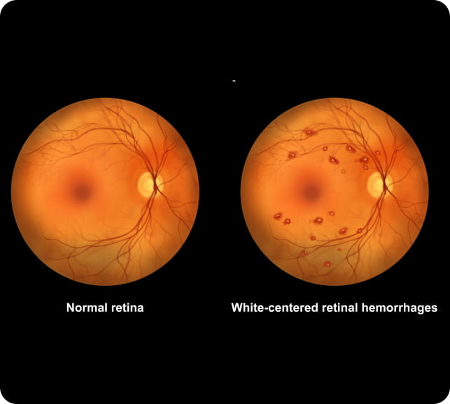 Side‑by‑side fundus images showing a normal retina and a retina with vascular changes from hypertensive retinopathy.